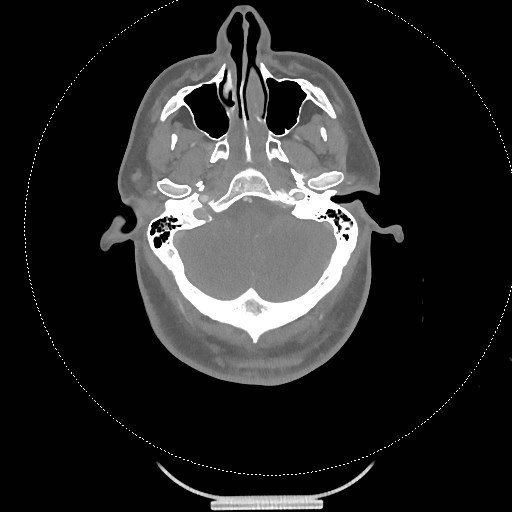 Neck CT angiogram (intraosseous vascular access) (Radiopaedia 55481-61945 B 262).jpg