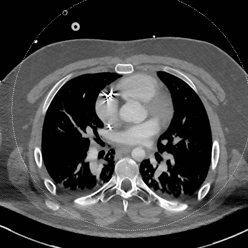 Neck CT angiogram (intraosseous vascular access) (Radiopaedia 55481-61945 B 6).jpg