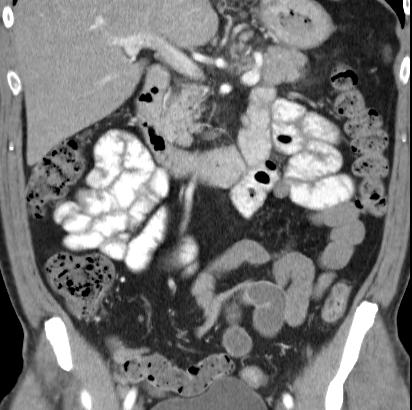 File:Necrotizing pancreatitis with acute necrotic collection (Radiopaedia 14470-14417 C 18).jpg