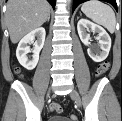 File:Necrotizing pancreatitis with acute necrotic collection (Radiopaedia 14470-14417 C 30).jpg