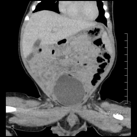 File:Neonatal neuroblastoma (Radiopaedia 56651-63438 Coronal non-contrast 19).jpg