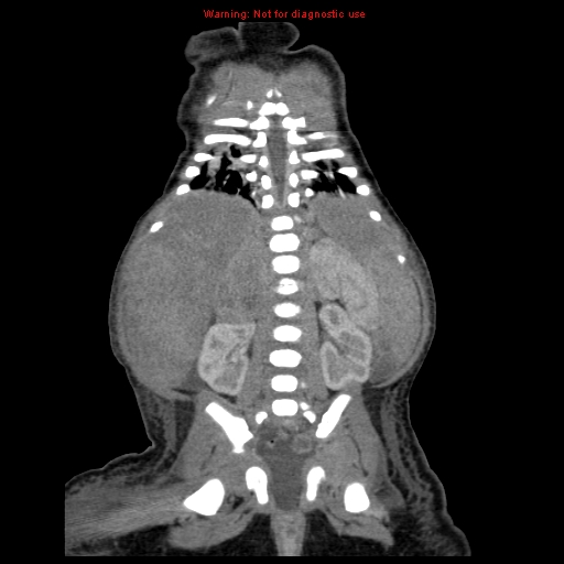File:Neonatal neuroblastoma (Radiopaedia 9564-10223 B 91).jpg