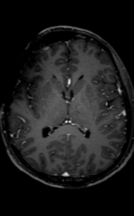 Neuro-Behçet disease (Radiopaedia 90112-107294 Axial T1 C+ 124).jpg