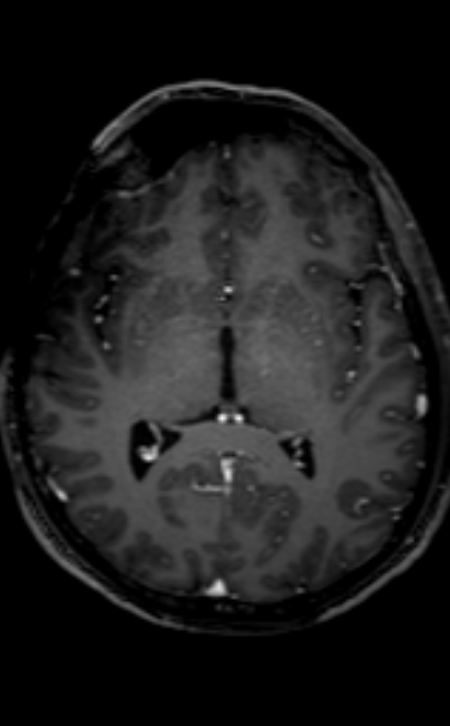 Neuro-Behçet disease (Radiopaedia 90112-107294 Axial T1 C+ 131).jpg