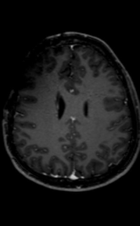 Neuro-Behçet disease (Radiopaedia 90112-107294 Axial T1 C+ 99).jpg