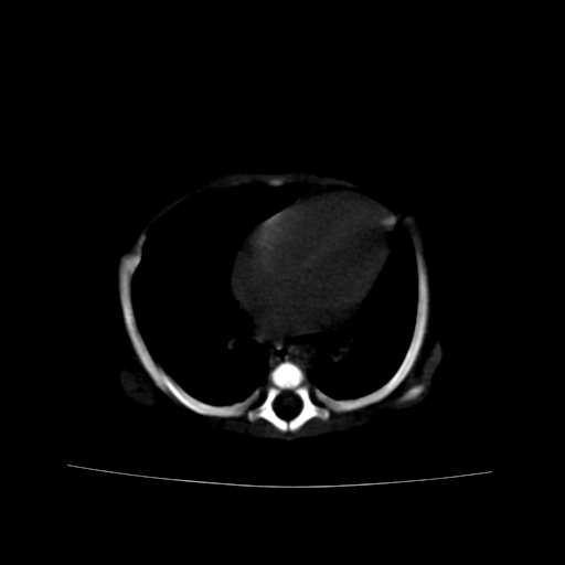 File:Neuroblastoma (Radiopaedia 20876-20799 Axial bone window 1).jpg