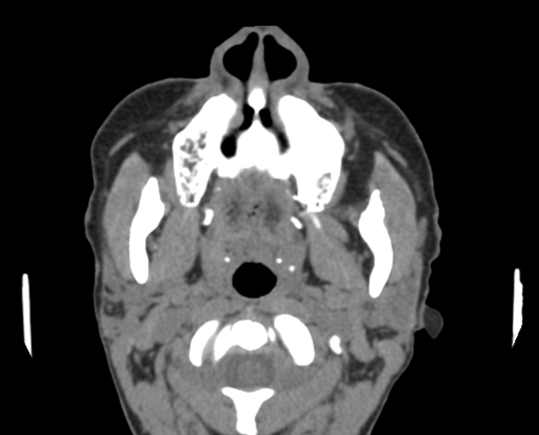 Neurofibromatosis type 1- orbital manifestations (Radiopaedia 49391-54511 Axial non-contrast 12).jpg