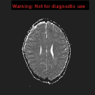 File:Neurofibromatosis type 1 with optic nerve glioma (Radiopaedia 16288-15965 Axial ADC 8).jpg