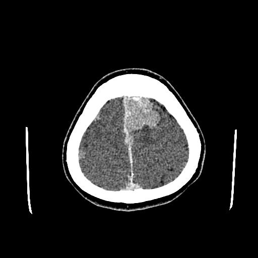 File:Neurofibromatosis type 2 (Radiopaedia 25389-25637 Axial C+ 88).jpg