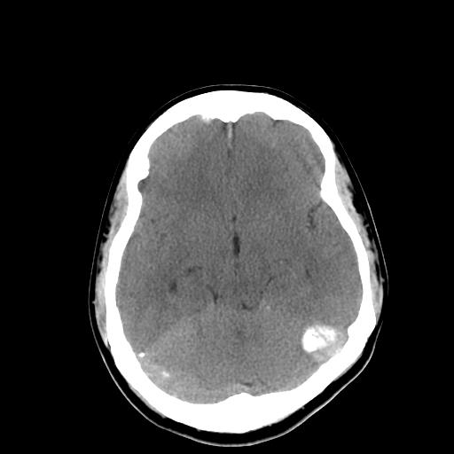File:Neurofibromatosis type 2 (Radiopaedia 25389-25637 Axial non-contrast 10).jpg