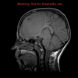 File:Neurofibromatosis type 2 (Radiopaedia 8953-9730 Sagittal T1 10).jpg