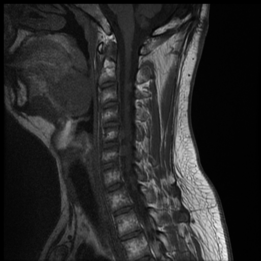 File:Neurofibromatosis type 2 (spinal manifestations) (Radiopaedia 53943-60070 Sagittal T1 5).png