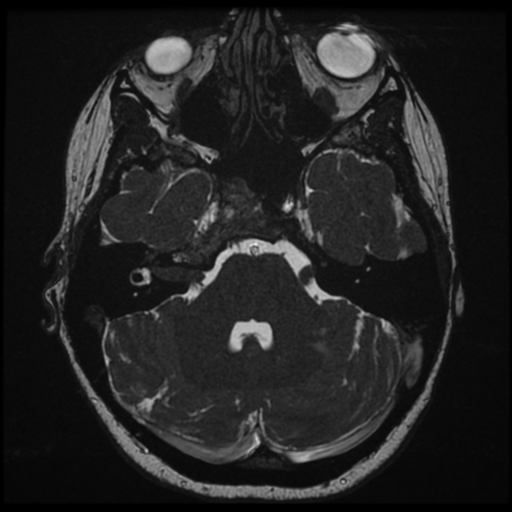 File:Neurofibromatosis type 2 - bilateral acoustic neuromata (Radiopaedia 40060-42566 Axial FIESTA 44).png