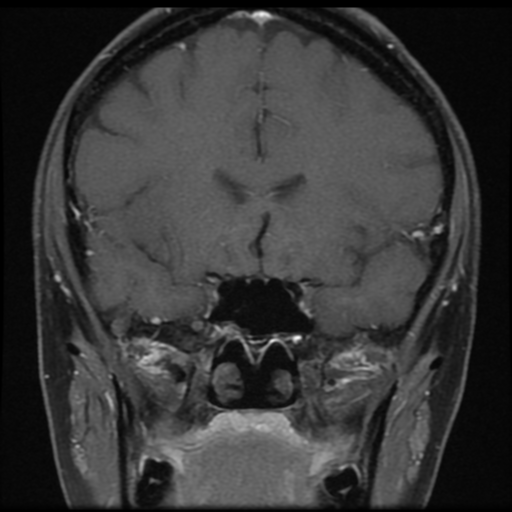 File:Neurofibromatosis type 2 - bilateral acoustic neuromata (Radiopaedia 40060-42566 Coronal T1 C+ 13).png