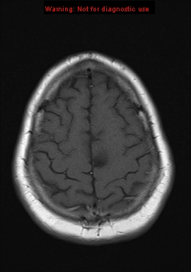 File:Neuroglial cyst (Radiopaedia 10713-11184 Axial T1 4).jpg