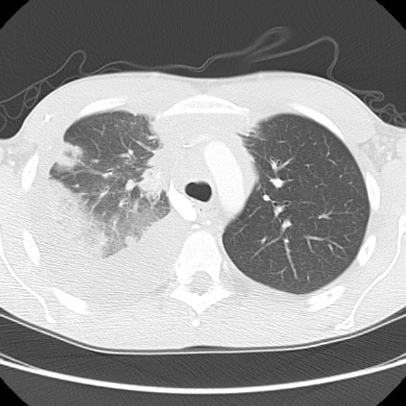 File:Non-Hodgkin lymphoma involving lung (Radiopaedia 29094-29470 Axial lung window 24).jpg