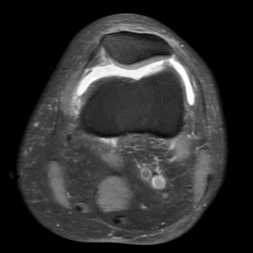 File:Non-displaced patella fracture (Radiopaedia 15932-15582 Axial PD fat sat 6).jpg
