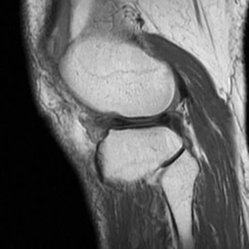 File:Non-displaced patella fracture (Radiopaedia 15932-15582 Sagittal T1 16).jpg