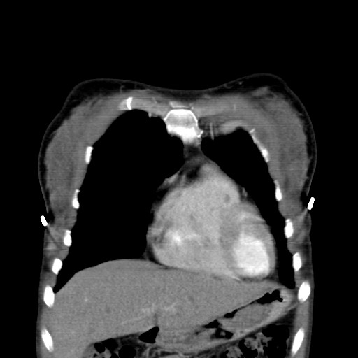 File:Non-small cell lung cancer with miliary metastases (Radiopaedia 23995-24193 B 3).jpg