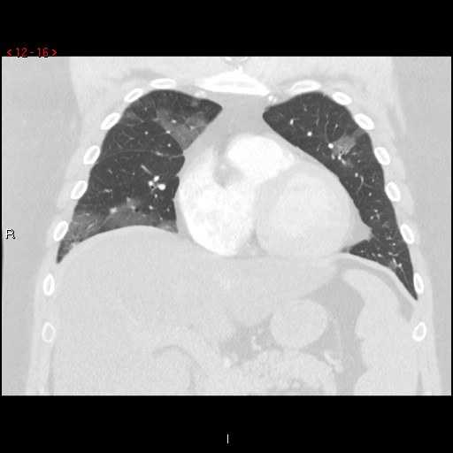 File:Non-specific interstitial pneumonitis (Radiopaedia 27044-27222 Coronal lung window 16).jpg
