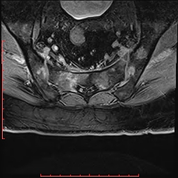 Non Hodgkin's lymphoma with metastasis to spine (Radiopaedia 54844-61103 Axial T1 C+ fat sat 39).jpg