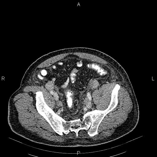 File:Non Hodgkin lymphoma in a patient with ankylosing spondylitis (Radiopaedia 84323-99621 B 55).jpg