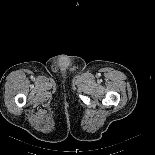 File:Non Hodgkin lymphoma in a patient with ankylosing spondylitis (Radiopaedia 84323-99621 B 72).jpg
