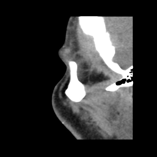 Normal CT paranasal sinuses (Radiopaedia 42286-45390 F 20).jpg