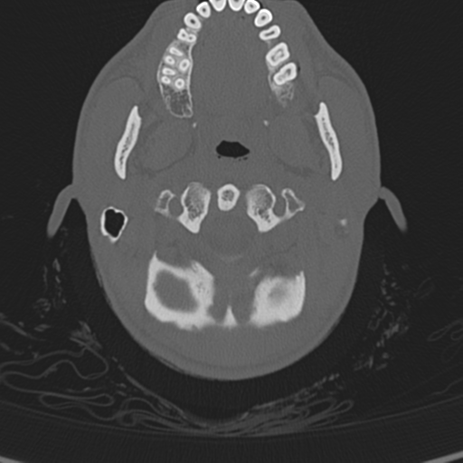 Normal CT skull (Radiopaedia 40798-43459 A 6).png