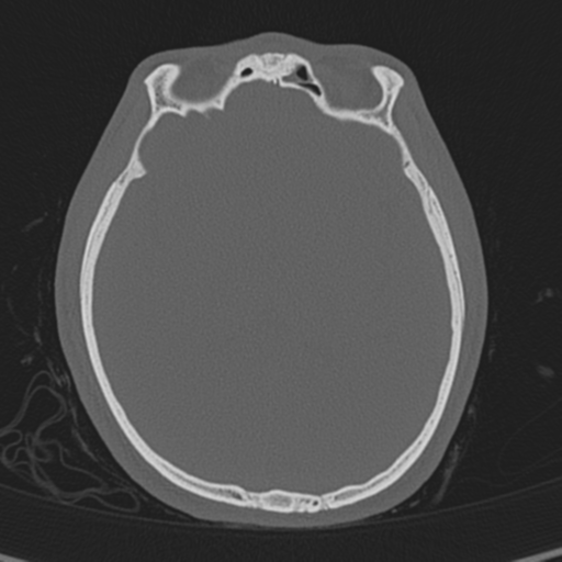 Normal CT skull (Radiopaedia 40798-43459 A 82).png