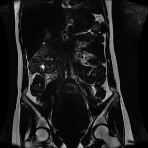 Normal MRI abdomen in pregnancy (Radiopaedia 88001-104541 N 71).jpg