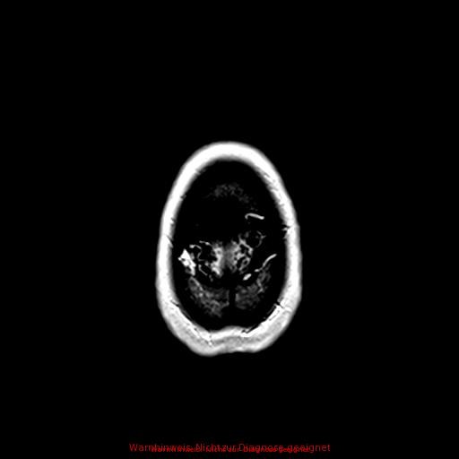 Normal adult brain MRI (non-enhanced and contrast-enhanced) (Radiopaedia 75262-86379 Axial T1 C+ 173).jpg