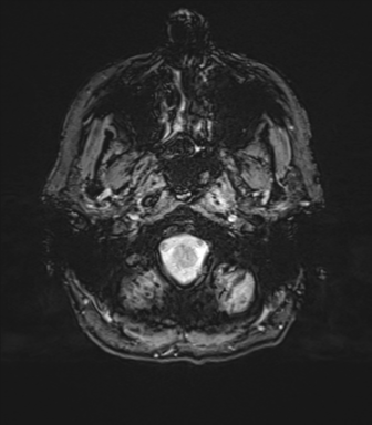 Normal brain MRI (TLE protocol) (Radiopaedia 40748-43405 Axial SWI 6).png