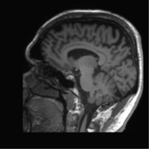 Normal brain MRI (non-focal epilepsy protocol) (Radiopaedia 53917-60040 Sagittal T1 38).png
