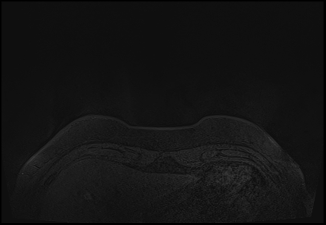 File:Normal breast MRI - dense breasts (Radiopaedia 80454-93850 Axial T1 2).jpg