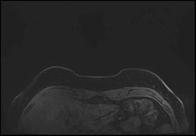 Normal breast MRI - dense breasts (Radiopaedia 80454-93850 C 6).jpg