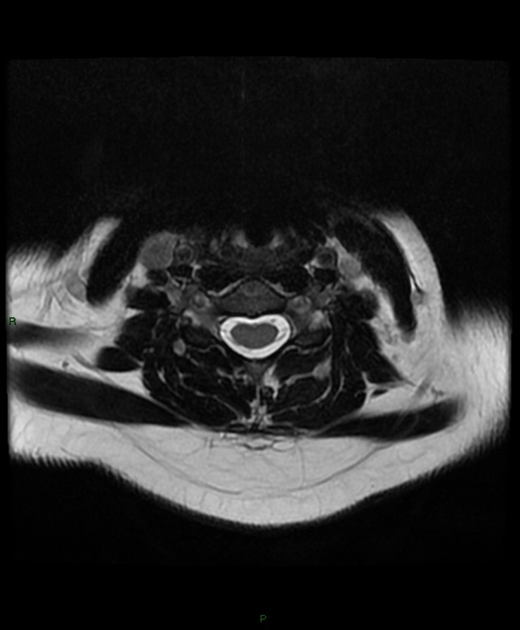 Normal cervical spine MRI (Radiopaedia 80146-93454 Axial T2 52).jpg