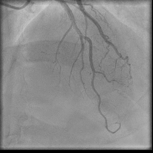 Normal coronary angiogram (DSA) (Radiopaedia 63081-71571 E 59).jpg
