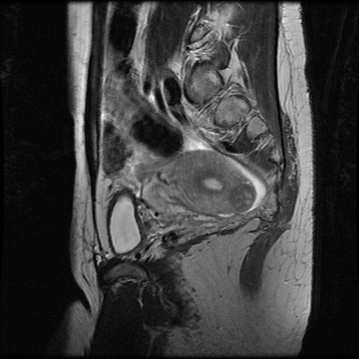 File:Normal female pelvis MRI (retroverted uterus) (Radiopaedia 61832-69933 Sagittal T2 23).jpg