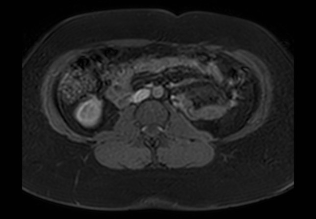 Normal liver MRI with Gadolinium (Radiopaedia 58913-66163 J 1).jpg
