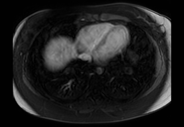 Normal liver MRI with Gadolinium (Radiopaedia 58913-66163 J 74).jpg