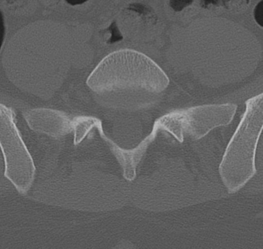 File:Normal lumbar spine CT (Radiopaedia 46533-50986 Axial bone window 64).png