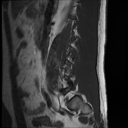 File:Normal lumbar spine MRI (Radiopaedia 35543-37039 Sagittal T1 12).png
