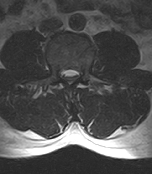 Normal lumbar spine MRI - low-field MRI scanner (Radiopaedia 40976-43699 Axial T2 54).jpg