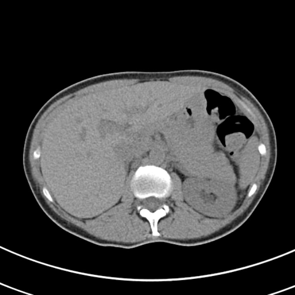 File:Normal multiphase CT liver (Radiopaedia 38026-39996 Axial non-contrast 20).jpg
