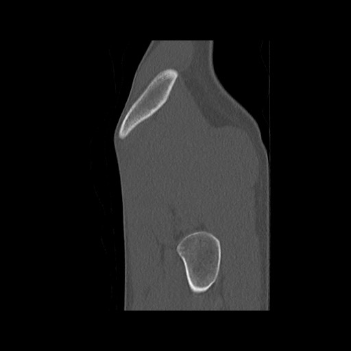 Normal pelvis (Radiopaedia 51473-57238 Sagittal bone window 139).jpg