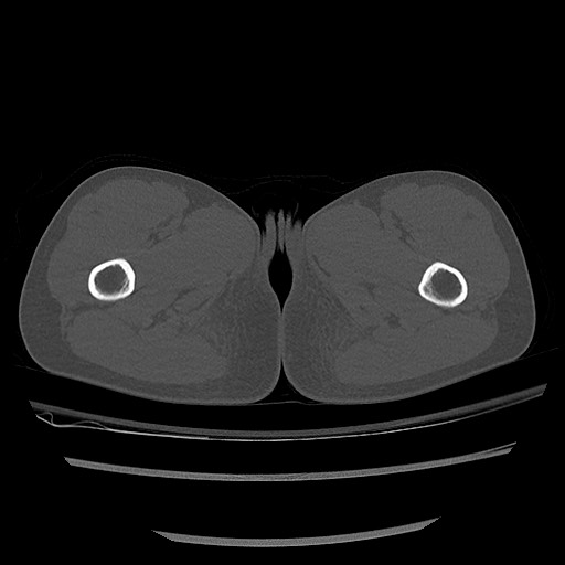 Normal pelvis CT (Radiopaedia 51471-57236 Axial bone window 108).jpg