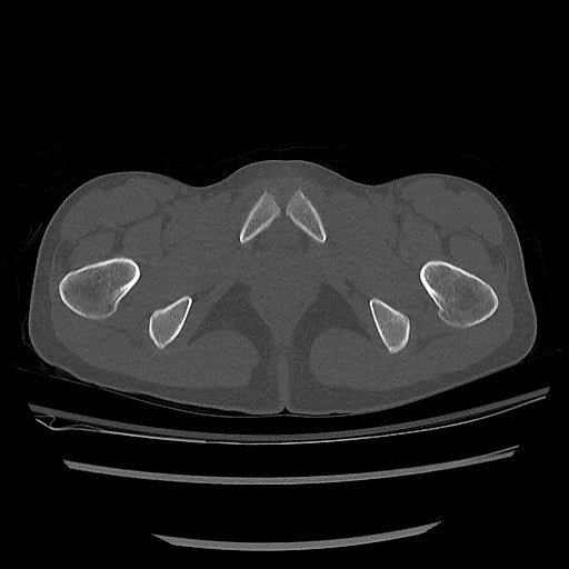Normal pelvis CT (Radiopaedia 51471-57236 Axial bone window 89).jpg