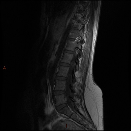 File:Normal spine MRI (Radiopaedia 77323-89408 Sagittal T1 9).jpg