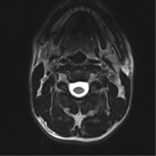 Normal trauma cervical spine (Radiopaedia 41017-43762 D 7).png